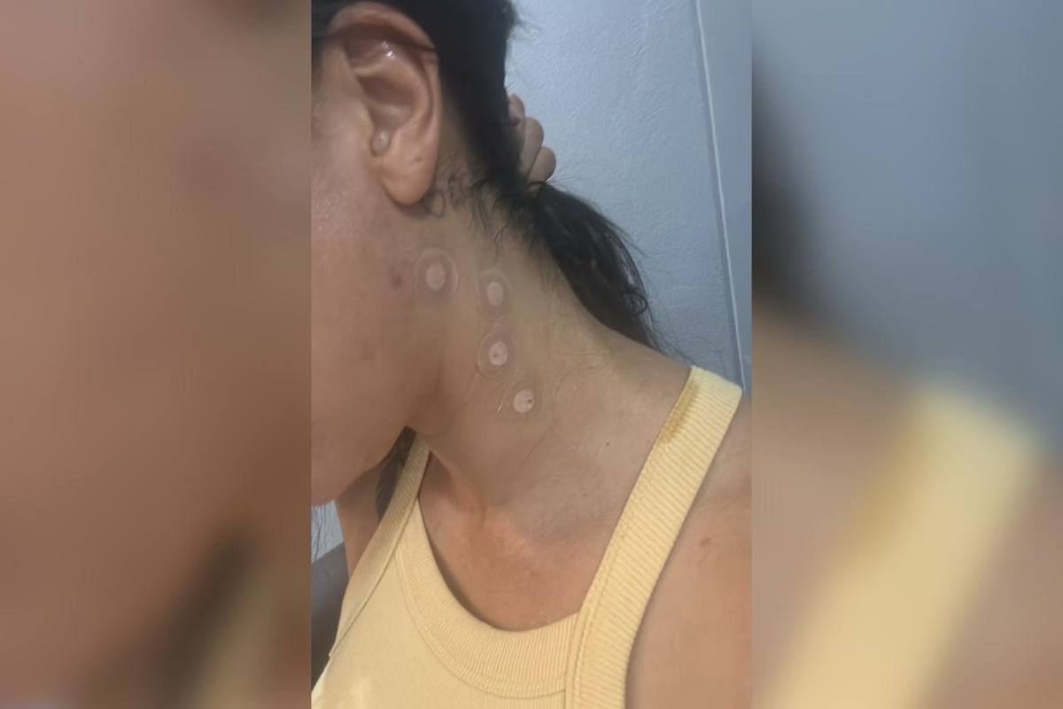 Foto colorida com foco no pescoço de uma mulher com pequenos curativso - Metrópoles.