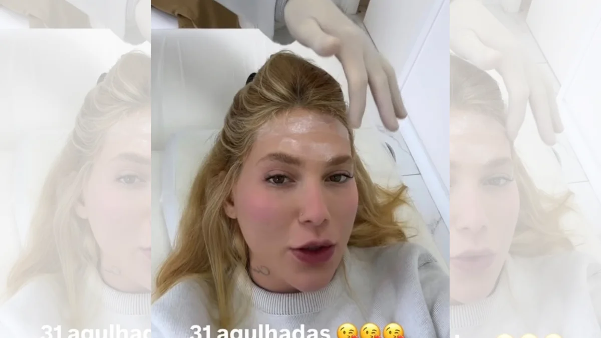 Virginia faz 31 aplicações de botox na cabeça; médica explica procedimento