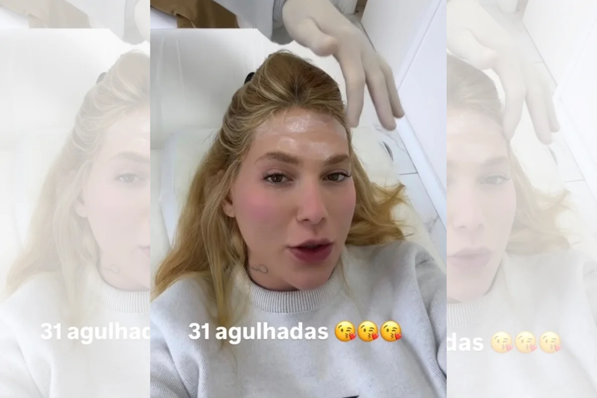Virginia faz 31 aplicações de botox na cabeça; médica explica procedimento