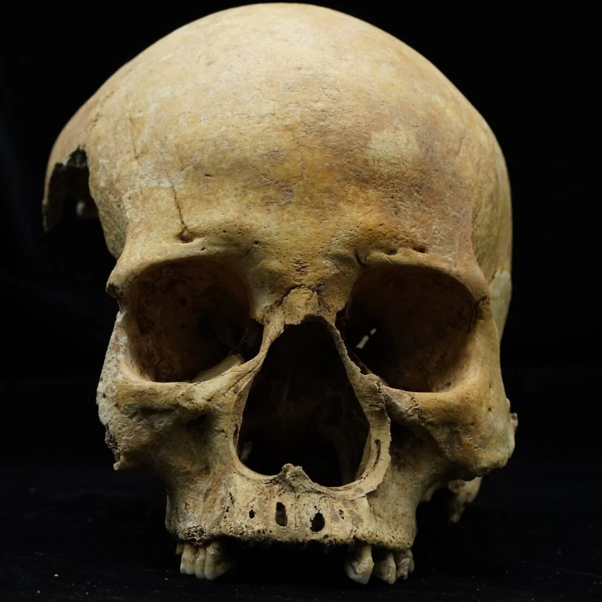 Mulher enterrada de bruços teve nariz amputado há cerca de 700 anos