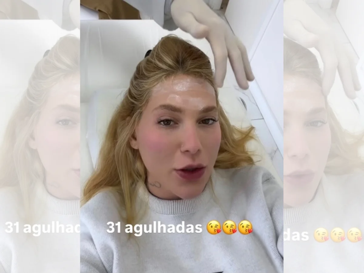 Virginia faz 31 aplicações de botox na cabeça; médica explica procedimento