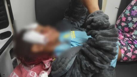 Menina de 7 anos leva pontos no rosto após cair de patinete ao fugir de cachorro em Contagem