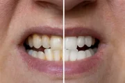 Dentista ensina o jeito certo de usar o fio dental e evitar o mau hálito